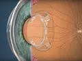 post_big/bionic-lens-how-it-works.jpg
