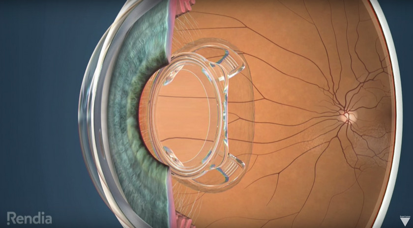 bionic-lens-how-it-works.jpg