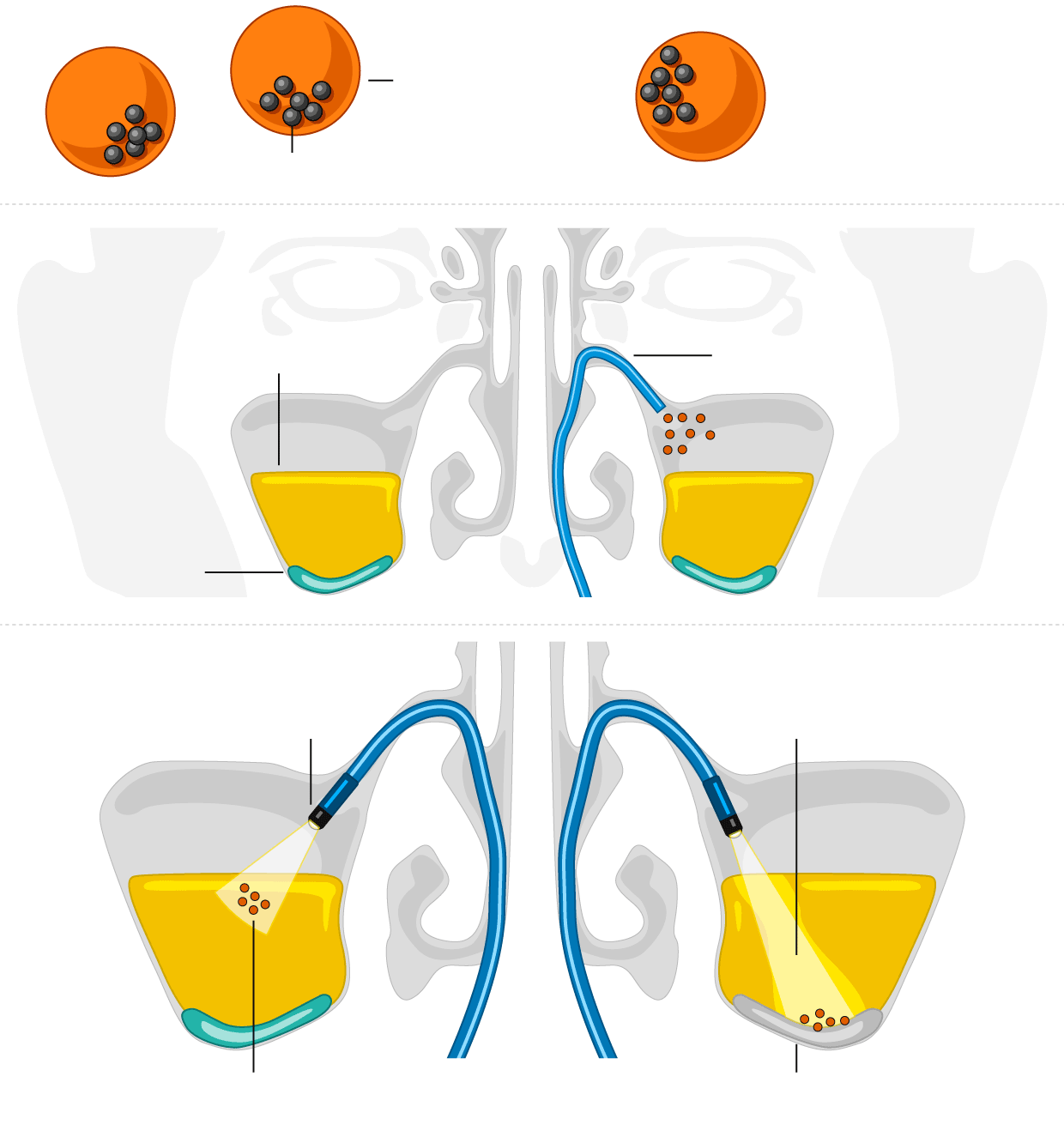 Illustration of microrobots for the treatment of sinusitis